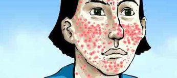 El acné aumenta el riesgo de suicidio