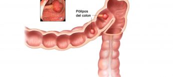 Cómo detectar un cáncer de colon