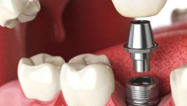 Dónde van los implantes dentales, prótesis, placas de acero o tornillos metálicos de un difunto tras su incineración