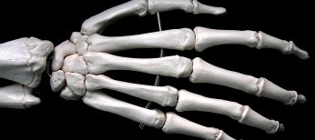 Huesos dañados por implantes de madera