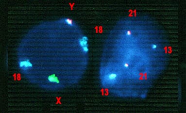 Cromosomas en la enfermedad rara SIA.