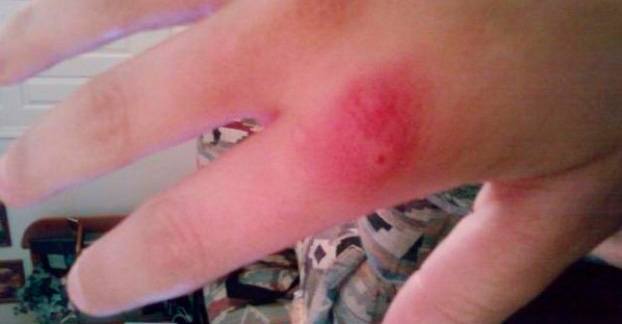 Cómo identificar una picadura y saber qué insecto es - Los 8 más comunes