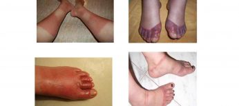 Cuidado al adquirir calzado: una sustancia toxica puede contaminar