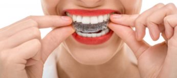 Ortodoncia o alineadores dentales, ¿qué es mejor?