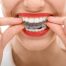 Ortodoncia o alineadores dentales, ¿qué es mejor?