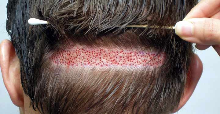 Técnica de la tira del trasplante capilar