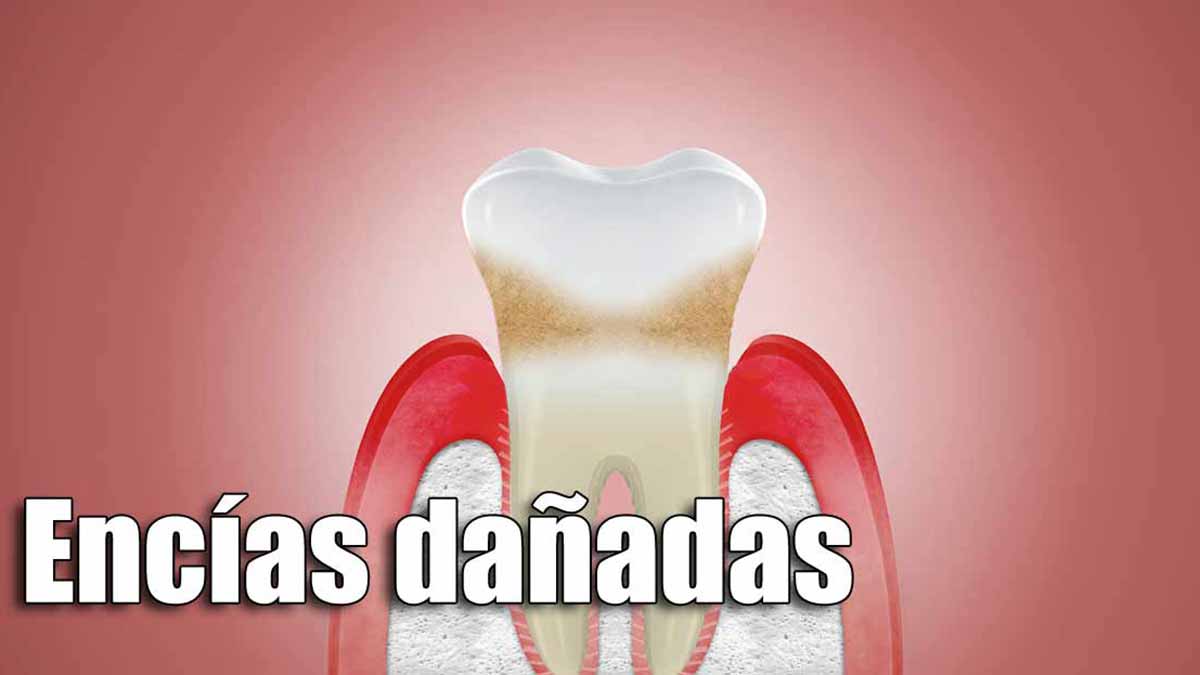 Inflamación de encías, tipos y remedios caseros