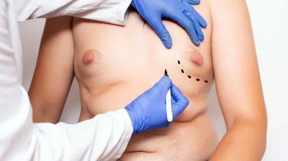 Abdomen, papada y pecho, las operaciones de estética para hombres mayores de 50.