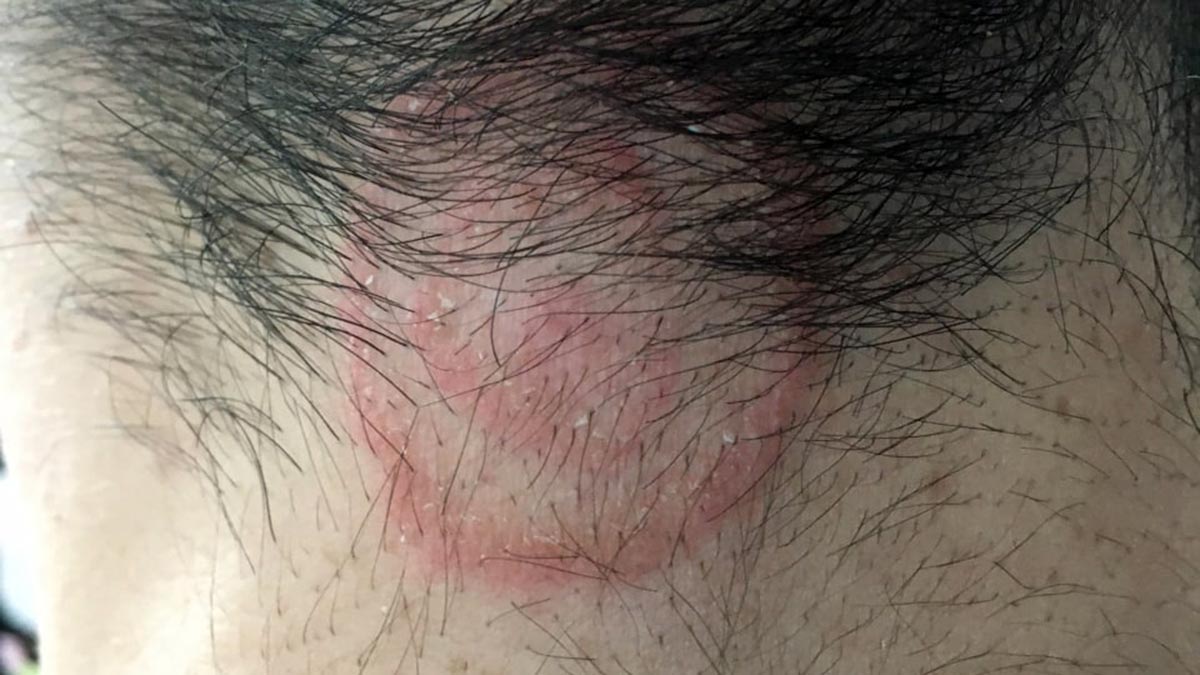 Síntoma de la tiña