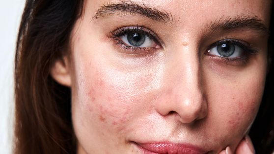 Cómo quitar las cicatrices y manchas de acné de la cara